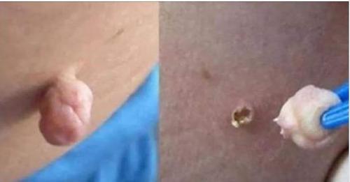 LAS BERRUGAS SE CAEN COMO OJAS CUANDO APLICA ESTE TRATAMIENTO CASERO.