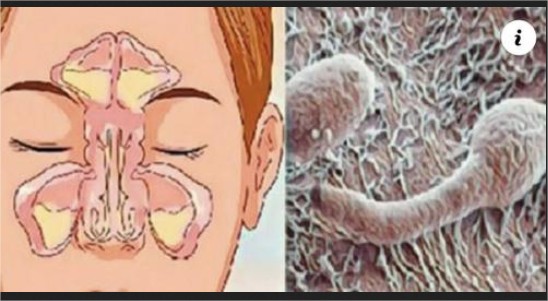 ¿Nariz Obstruida, Rinitis O Sinusitis? ¡Su Problema Está En El Intestino