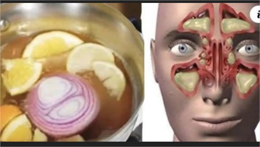 ACABA CON LA SINUSITIS