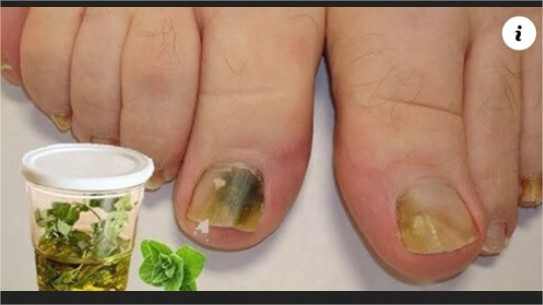 LOS HONGOS DE TUS UÑAS SE SECARÁN POR COMPLETOS
