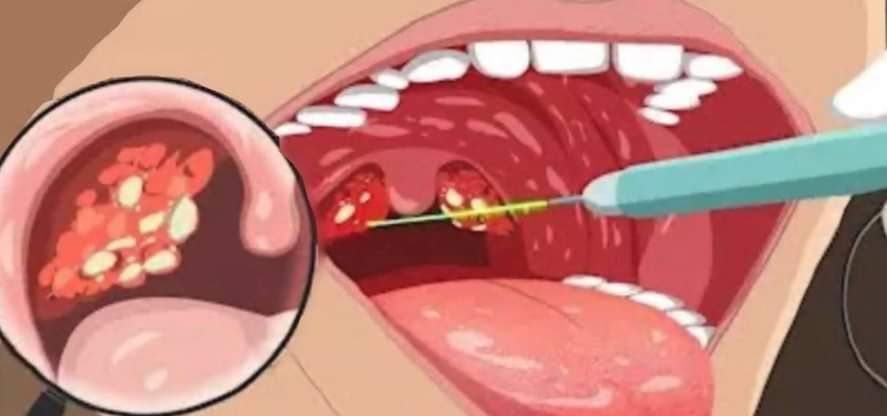 infecciones de la garganta