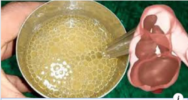 Remedio para el estreñimiento