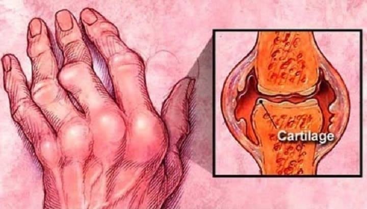 15 AÑOS MI MÉDICO LUCHANDO CON MI ARTRITIS Y ESTA HIERBA HIZO QUE DESAPARECIERA EN 15 DÍAS.