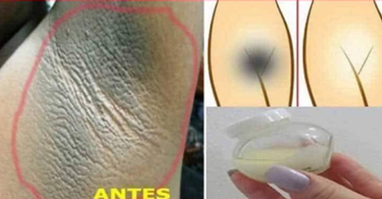 ELIMINAR LAS MANCHAS OSCURAS