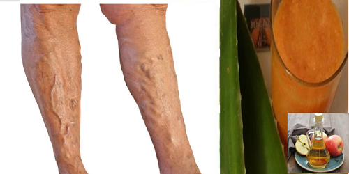 Venas Varicosas