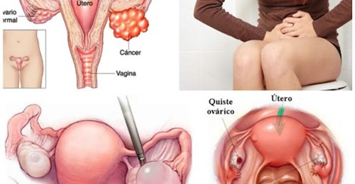 LIMPIA TU ÚTERO Y OVARIOS CON ESTOS REMEDIOS NATURALES