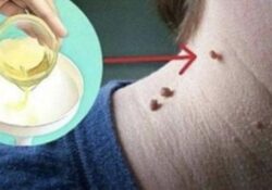 ELIMINA TUS MANCHAS DE EDAD, LUNARES, VERRUGAS Y ESPINILLAS DE LA PIEL COMPLETAMENTE NATURAL