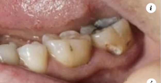 Caries