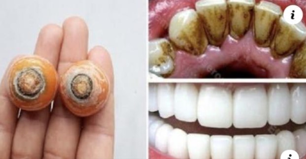 Blanqueamiento de dientes