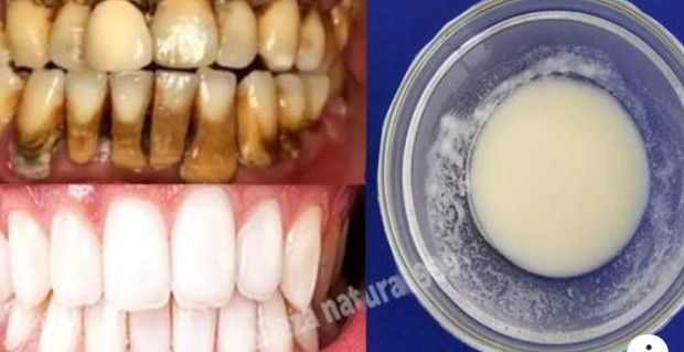 BLANQUEA TUS DIENTES Y ELIMINA TUS CARIES