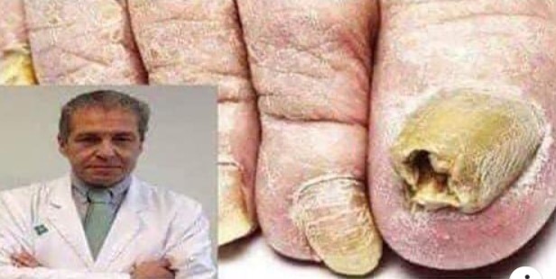 DILE ADIOS A LOS HONGOS EN LAS UÑAS