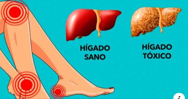 SIGNS OF A FATTY LIVER